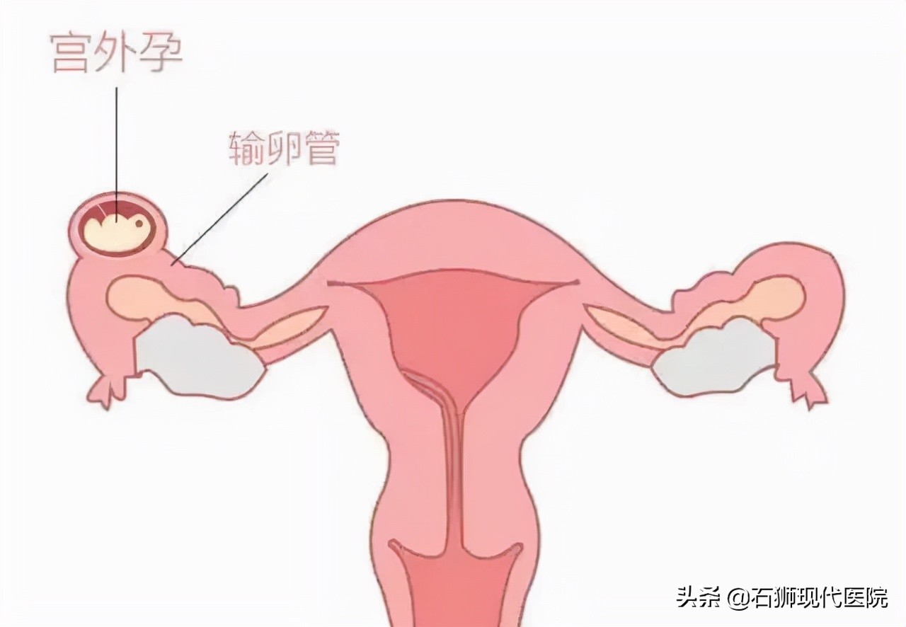 巧于伪装、随时引爆、危及生命!你想不到的「宫外孕」