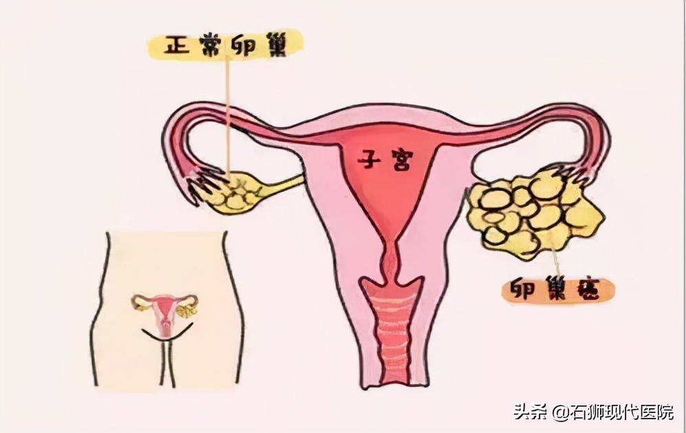 20多岁女孩肚子痛查出卵巢囊肿，没有X生活为啥还会得妇科病？