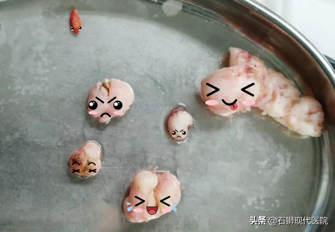 大家好，我是一枚10岁的子宫肌瘤