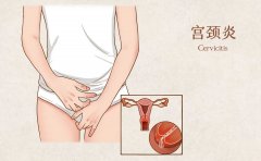 啥？！宫颈炎会导致宫颈癌？