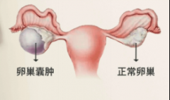 发现卵巢囊肿怎么办？先别急！