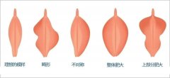 什么样的阴唇需要矫正？