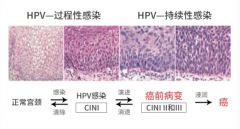 HPV不可怕，及时治疗才是关键！