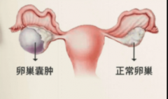 发现卵巢囊肿怎么办？