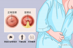 急性宫颈炎应对指南：5个关键步骤助你
