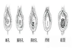 女性的处女膜到底是怎么一回事？到底